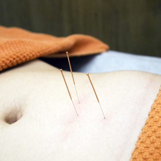 Acupuncture